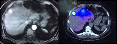 Insights into handling and delivery of Y-90 radioembolization therapies